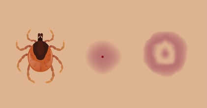 Illustration of a tick and a tick bite.
